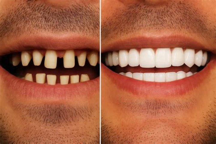 Ronda Rousey | Teeth Before And After