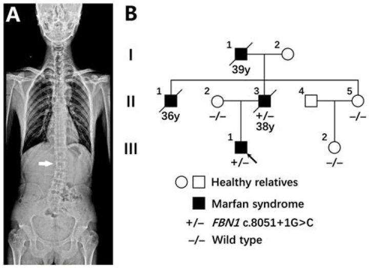 What Happened To Marfan Mike? Coma Survivor Death Cause, Marfan Syndrome Update